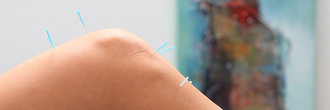 Akupunktur - Leistungen der Orthop&auml;dischen Gemeinschaftspraxis