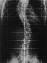 R&ouml;ntgenbild Skoliose